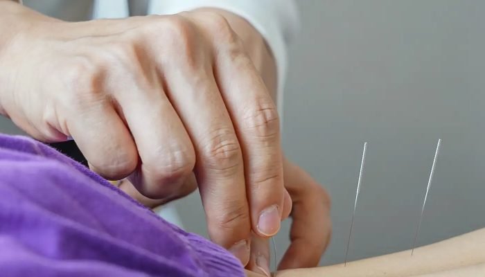 acupuntura.jpg